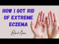 I suffered with extreme eczema or dermatitis until I discovered how to neurologically mind change my